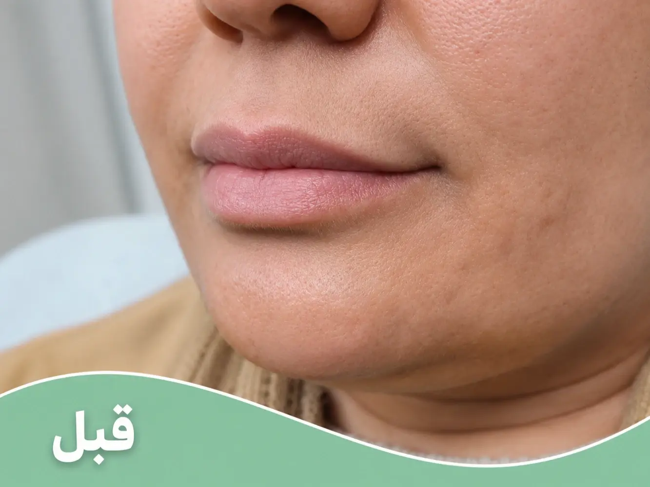 قبل و بعد تزریق فیلر لب و چانه قبل از انجام خدمت