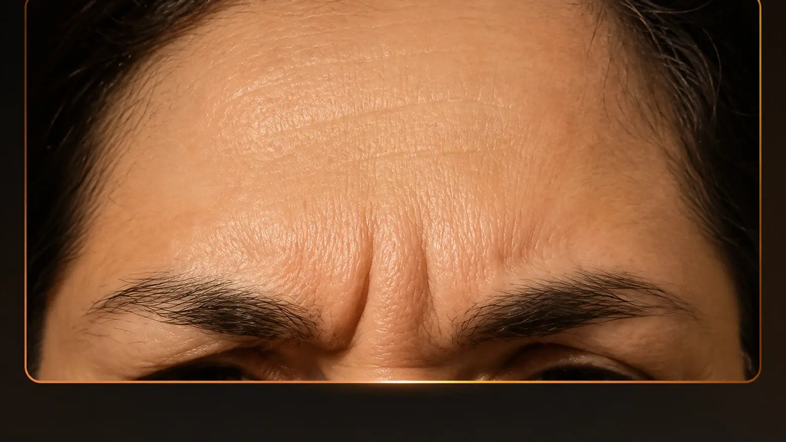 Before and After Botox Injection Before