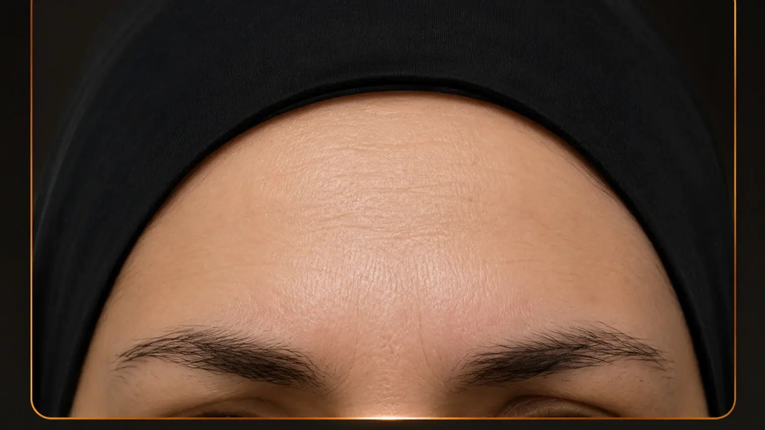 Before and After Botox Injection After