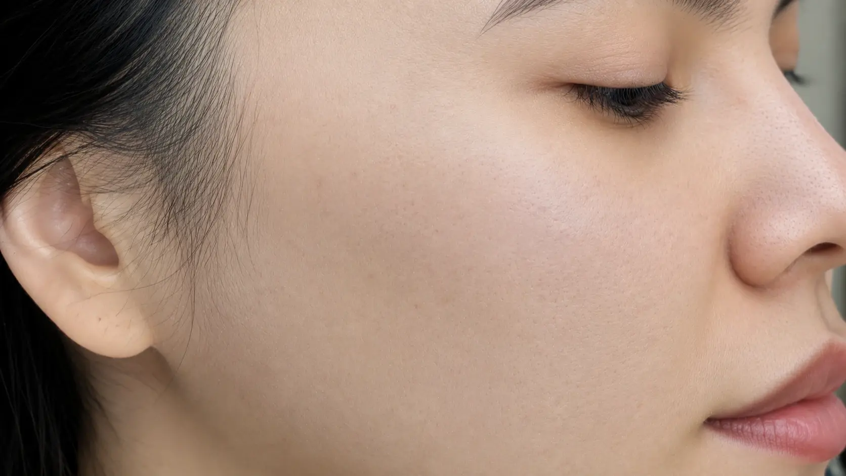 Microneedling+PRP Result after the service
