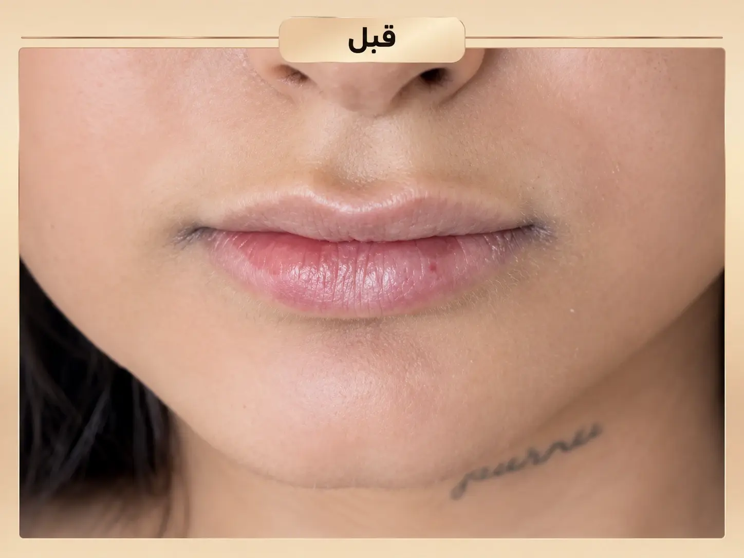 تزریق فیلر لب قبل از انجام خدمت