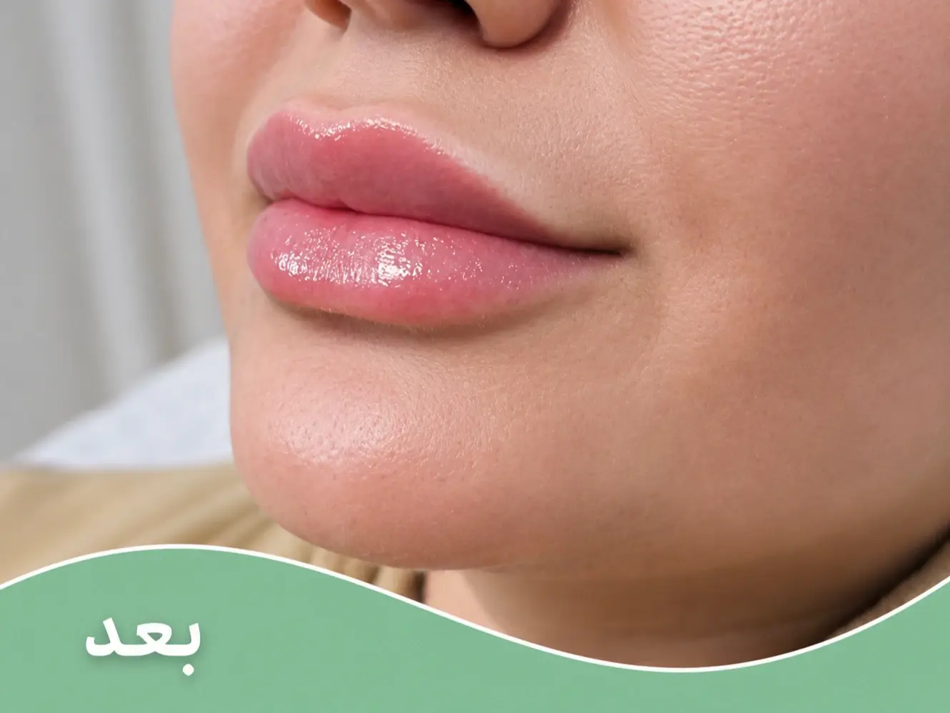 قبل و بعد تزریق فیلر لب و چانه بعد از انجام خدمت