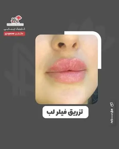 تزریق فیلر لب
